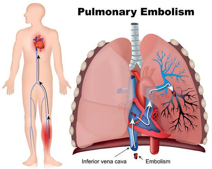 Pulmonary Embolism