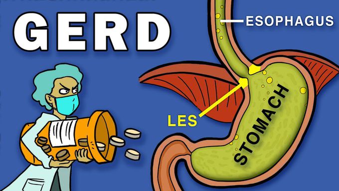 gastroesophageal reflux disease(GERD)