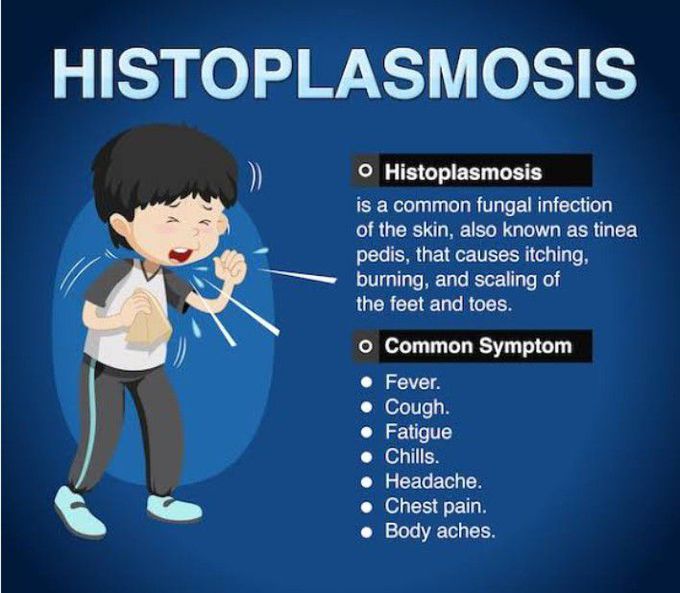 Symptoms of Histoplasmosis