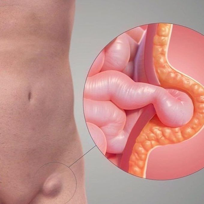 Inguinal hernia