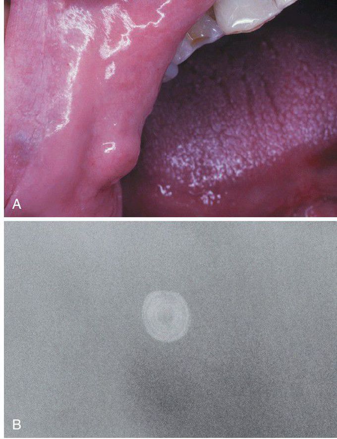 Sialolithiasis