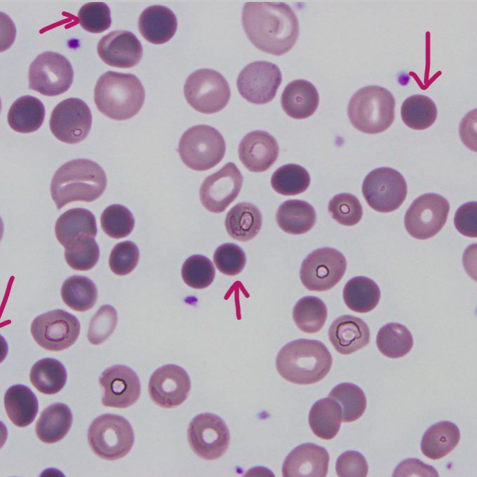 Spherocytes in autoimmune hemolytic Anemia