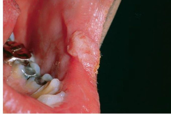 Secondary syphilis Oral lesion