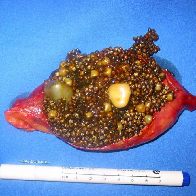 Cholelithiasis