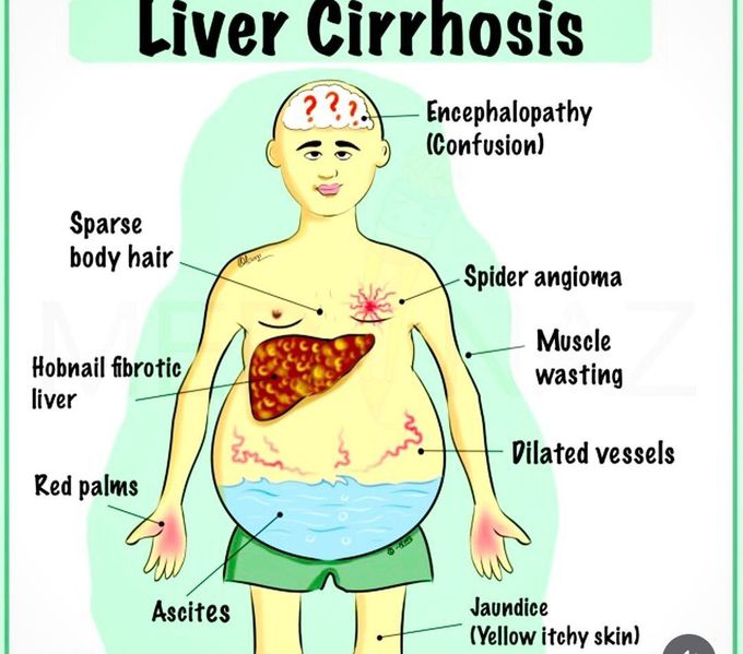 Liver Cirrhosis