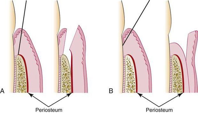 Full thickness flap Vs Split thickness flap