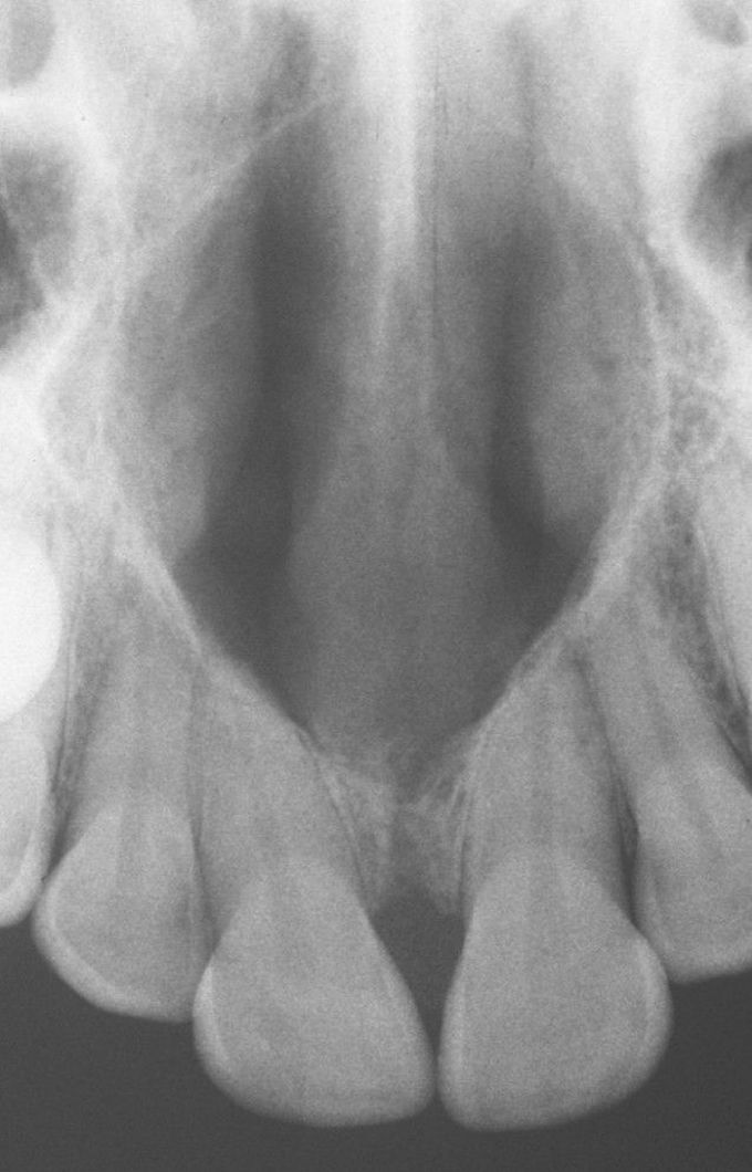 Nasopalatine duct cyst