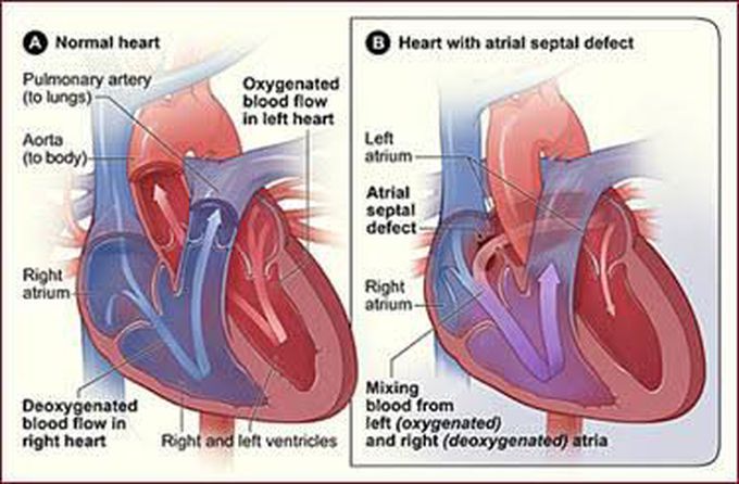 Atrial Septal Defect