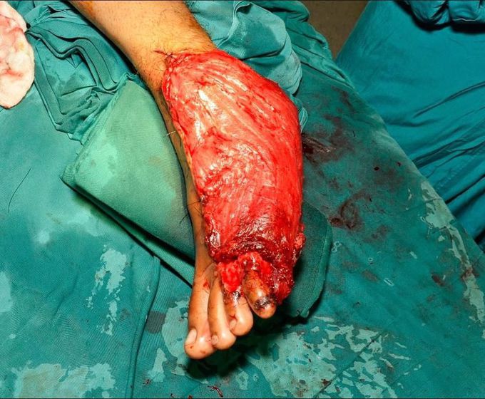 [PART 2] A gentleman was injured in a road traffic accident when the oil tanker in which he was travelling overturned and he got crushed beneath the tanker. 