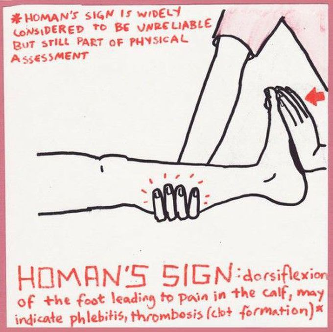 Homan's sign
