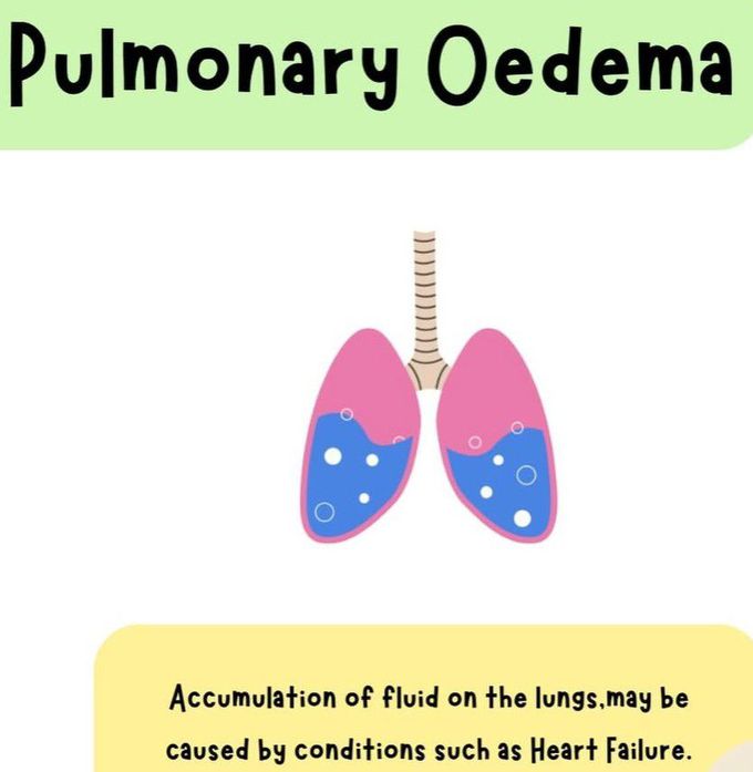 Pulmonary Edema