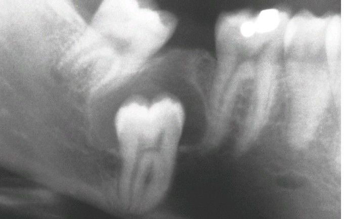 Dentigerous Cyst.