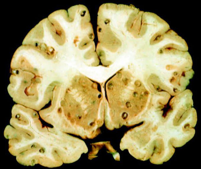 Neurocysticercosis