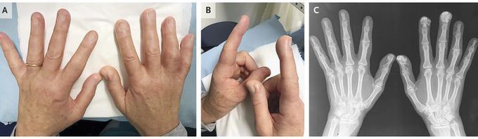 Calcinosis in Systemic Sclerosis