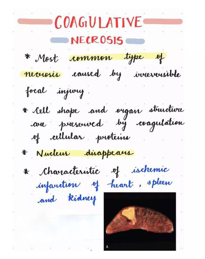 Coagulative necrosis