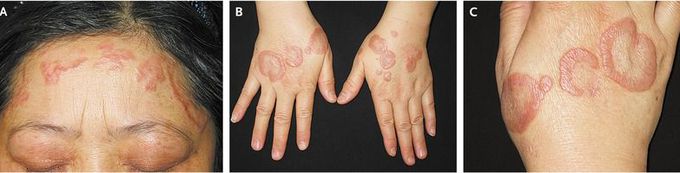 Actinic Granuloma