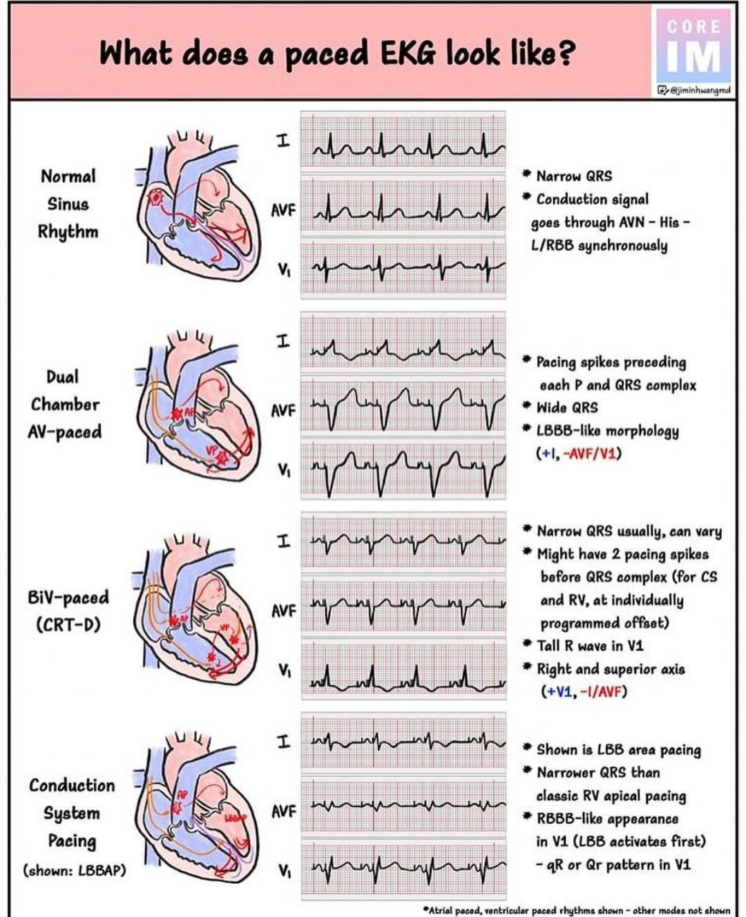 Paced EKG - MEDizzy