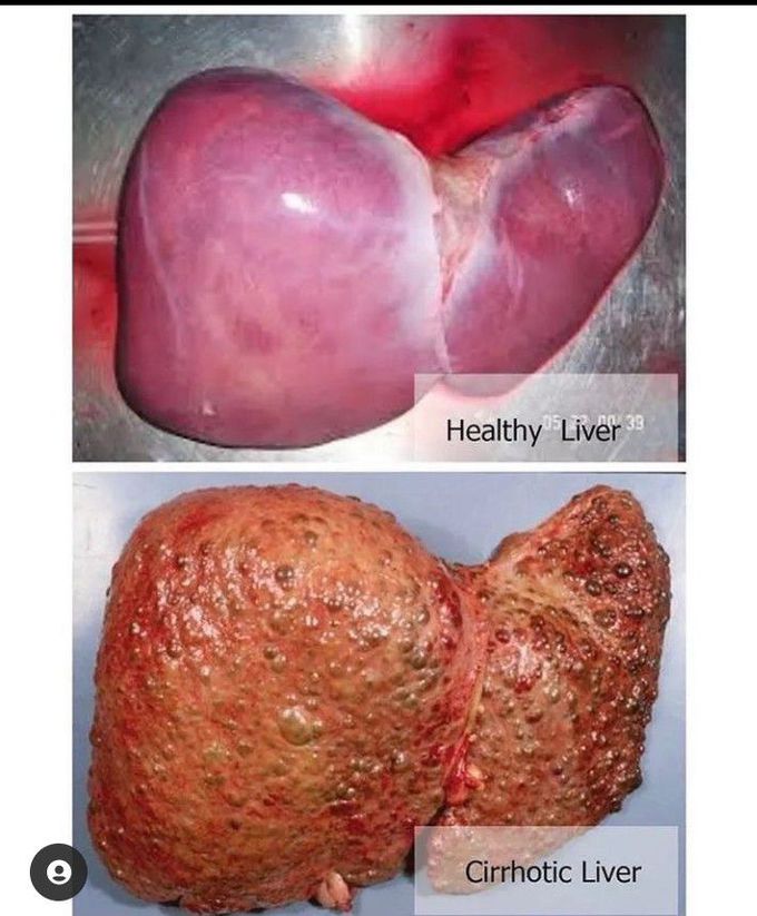 Difference between healthy and cirrhotic liver (pictorial pesentation)