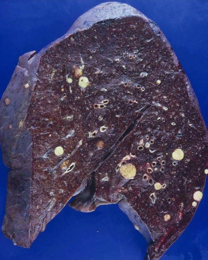 Hepatocellular carcinoma