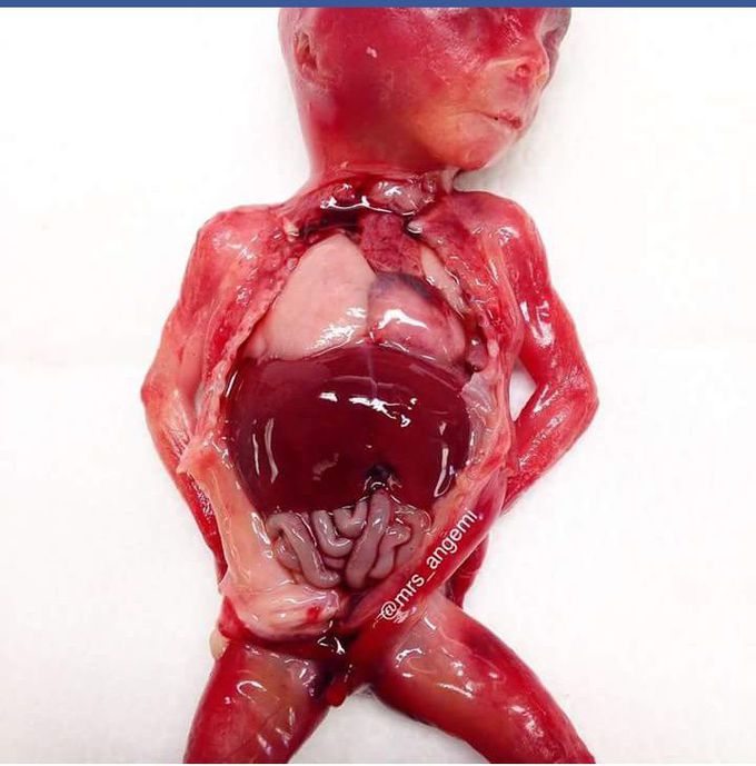 Autopsy Of A Fetus