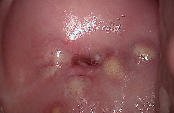 Nabothian Cyst