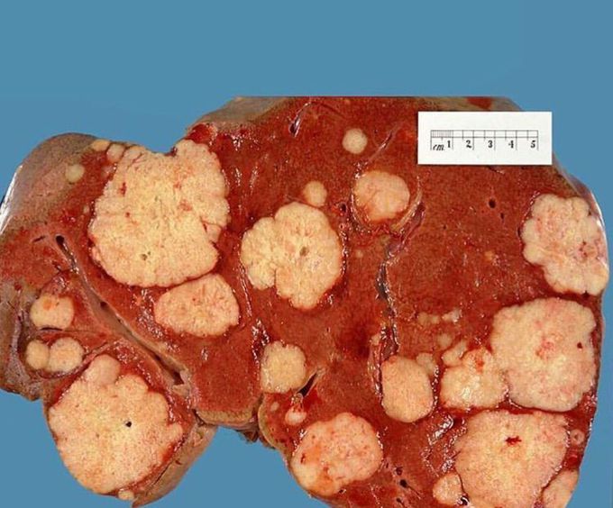 Liver Metastasis