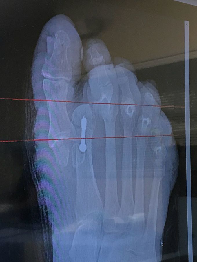 Parkinson’s patient 4 days post bunionectomy