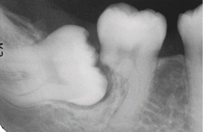 Impaction-Related Tooth Resorption.