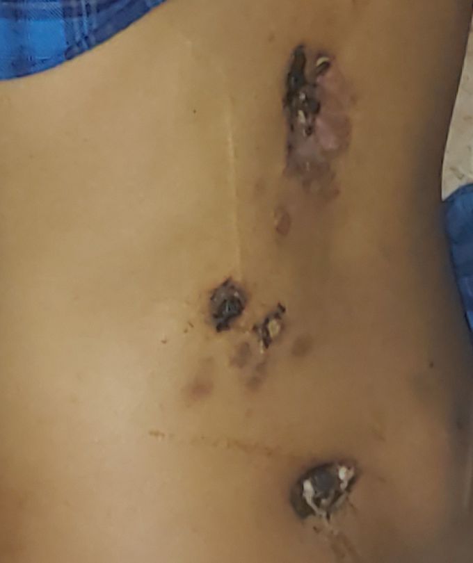 25 years male with severe pain from past 5 months