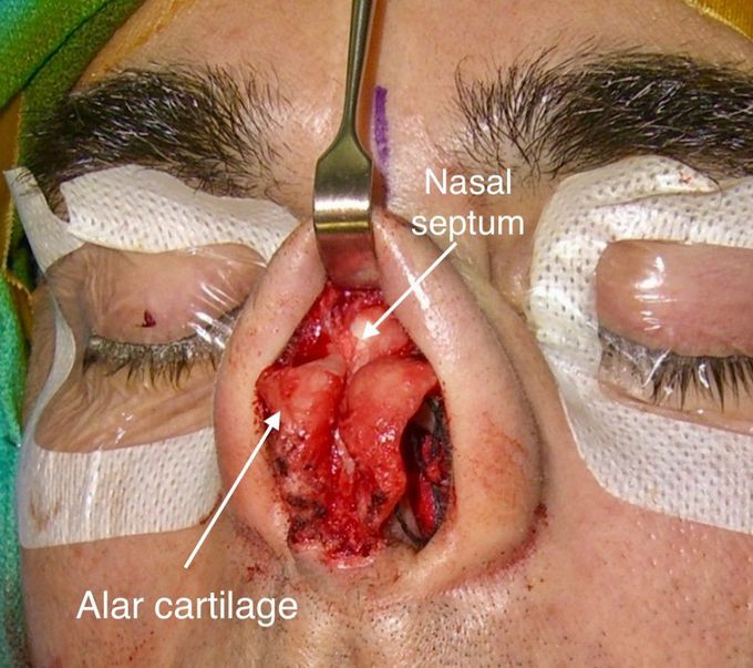 Rhinoplasty