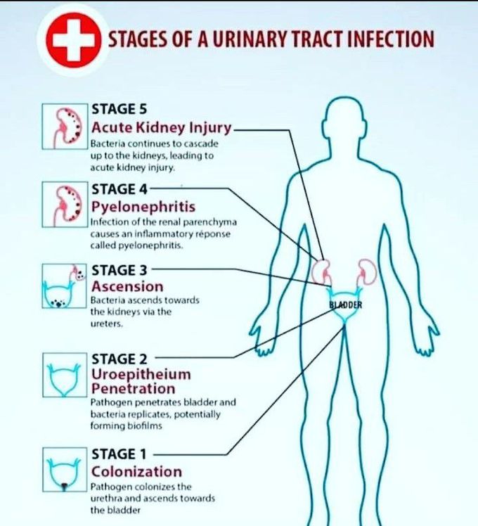Stages of UTI