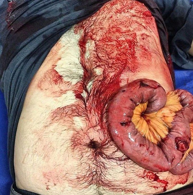 Abdominal herniation with infection