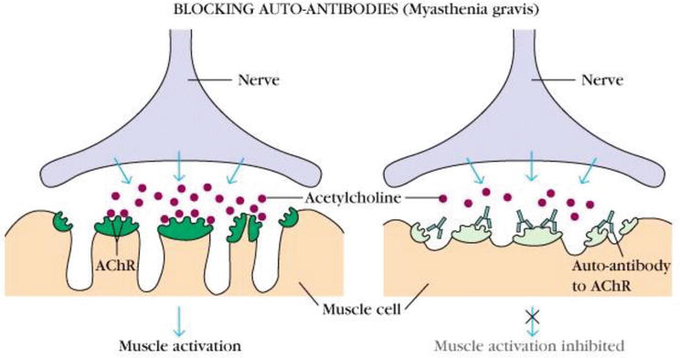 Cause of Myasthenia gravis