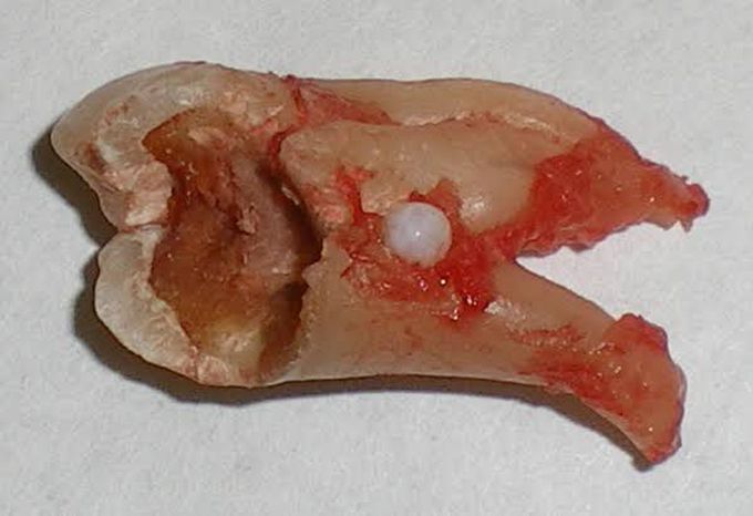 Treatment of enamel pearls