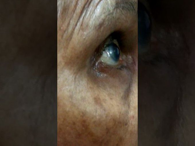 Pulsatile Exophthalmos