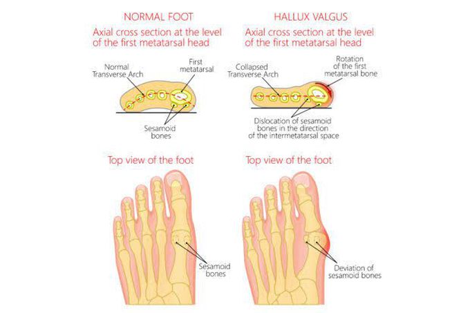 Hallux Valgus