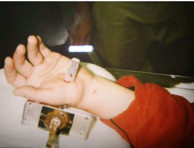 Penetrating injury to hand