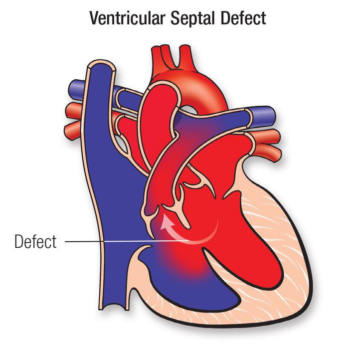 Ventricular Septal Defect Medizzy 5505