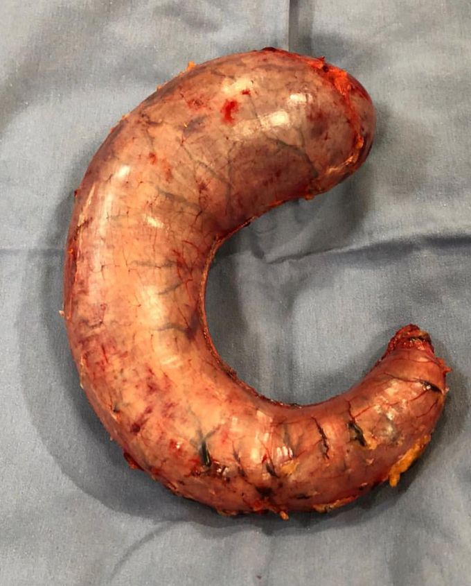 Sleeve gastrectomy!