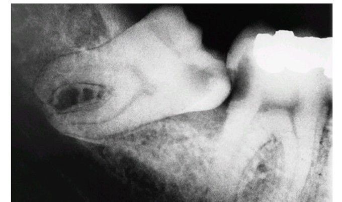 Sequela of an impacted 3rd molar