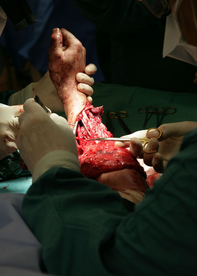 Hand transplant surgery