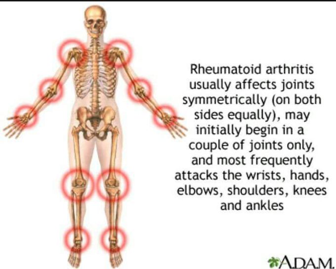 Rheumatoid arthritis