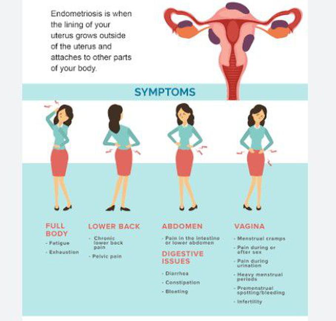 Endometriosis - MEDizzy