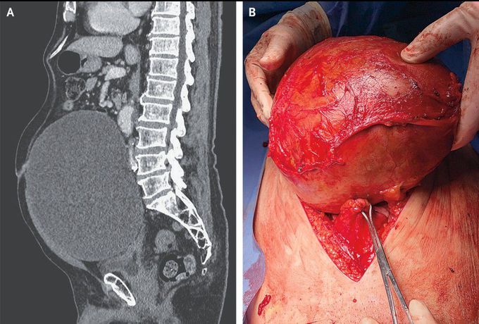 A Large Abdominal Mass