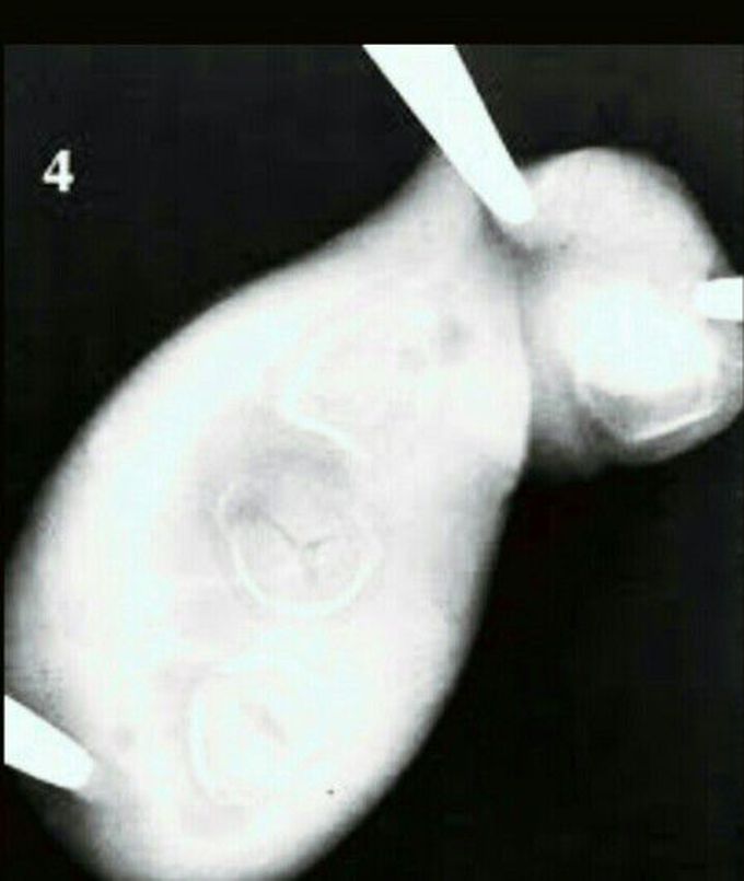Xray gall bladder.Which sign and Diagnosis?