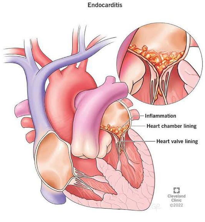 Endocarditis treatment