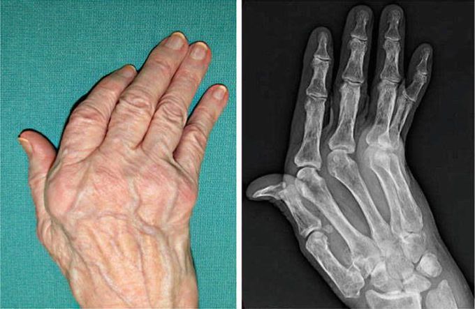 Rheumatiod Arthritis