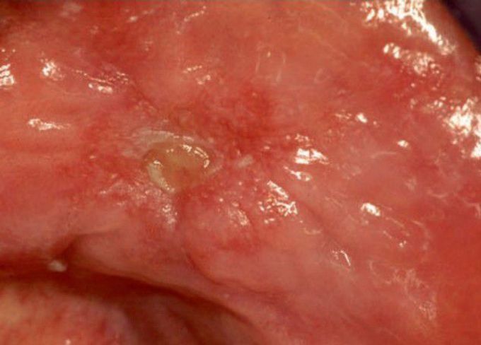 Ulcer associated with excessive heat from hydrocolloid 
impression material.