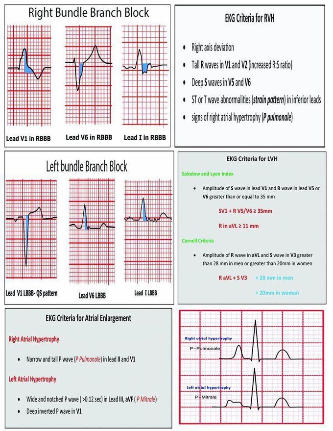EKG criteria