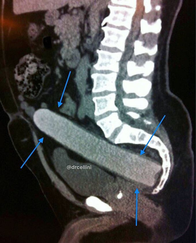 This case was sent in by one of the #Tribe @drcellini a Radiology Resident.